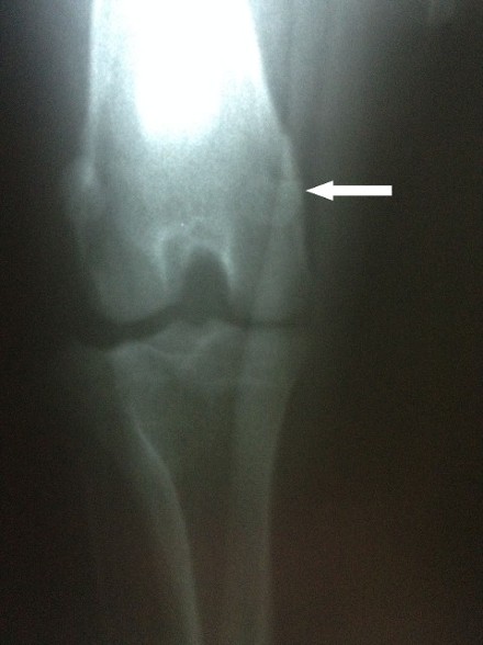 bone cancer dogs